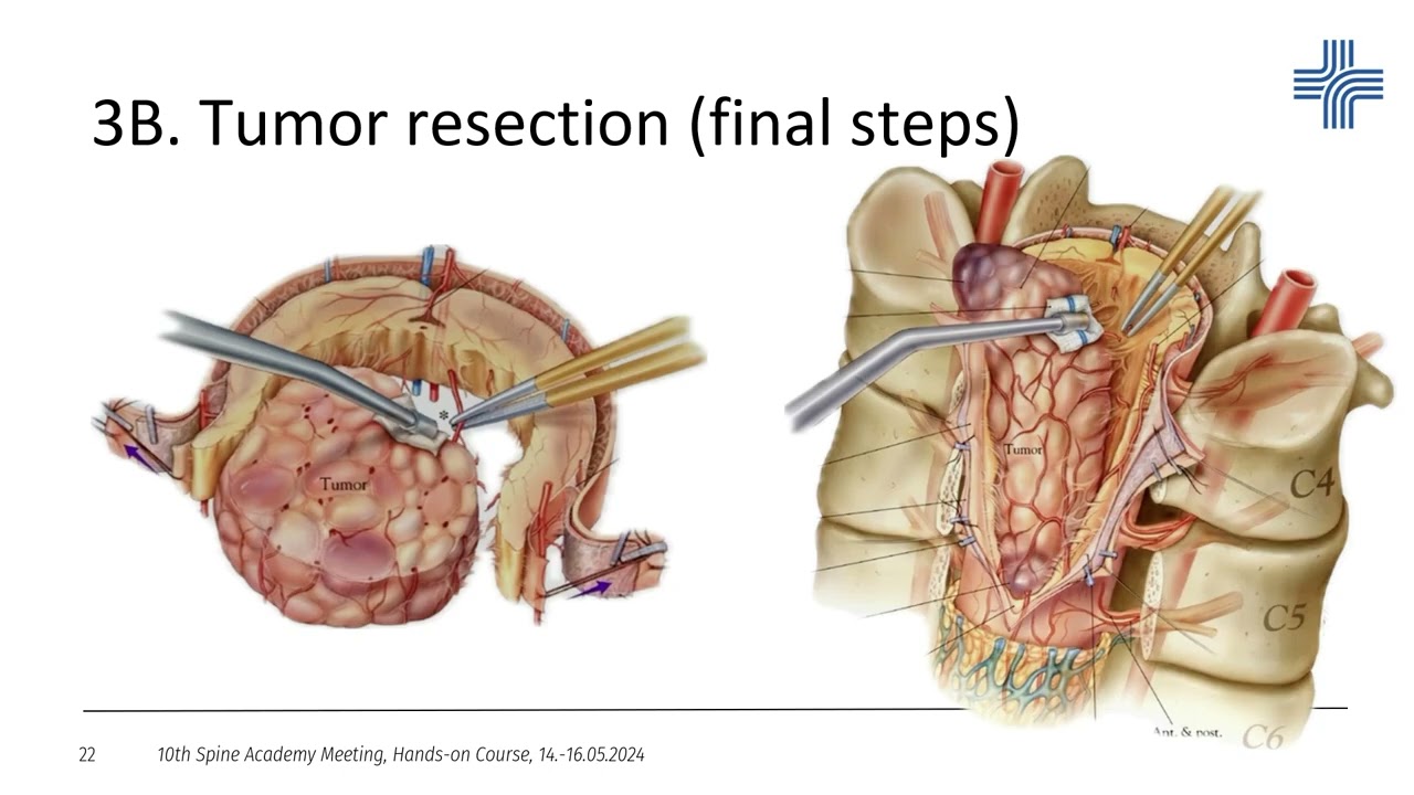 Medical Lecture: Spine Academy, Prof. Gousias