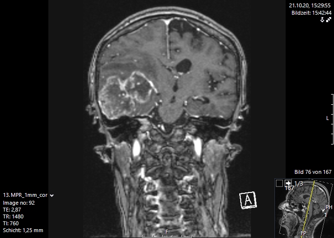 εγκεφαλικές μεταστάσεις