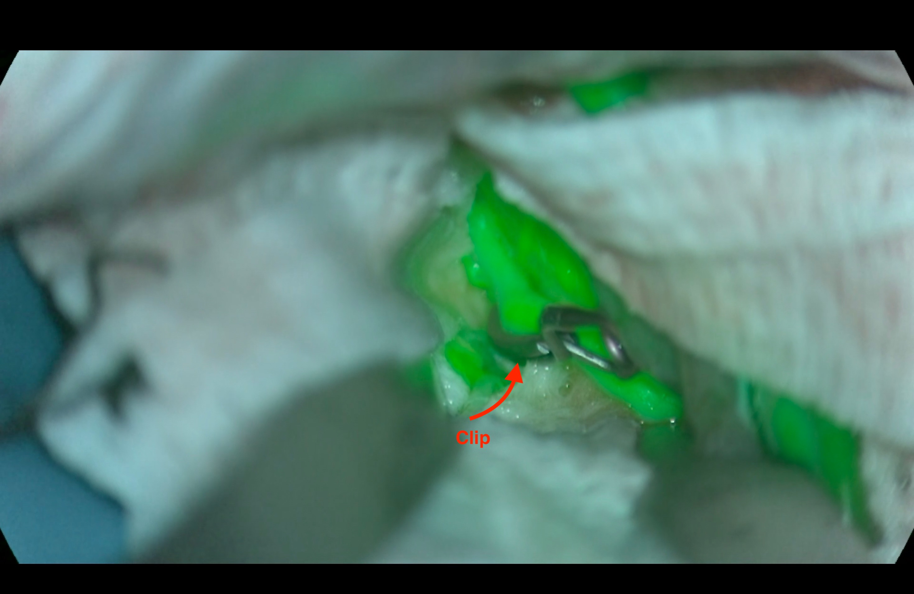 Ανευρύσματα 