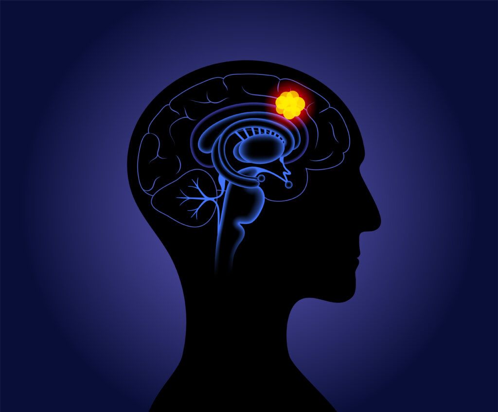 γλοιοβλάστωμα εγκεφάλου