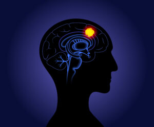 γλοιοβλάστωμα εγκεφάλου